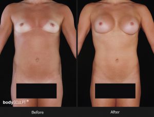 Composite Breast Augmentation - Patient 2