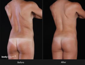 Composite Breast Augmentation - Patient 2