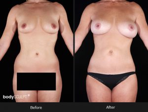 Composite Breast Augmentation - Patient 3