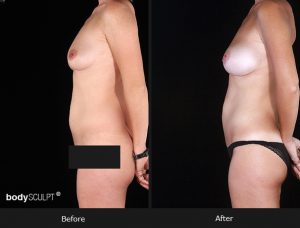 Composite Breast Augmentation - Patient 3