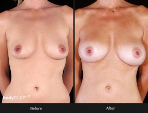 Composite Breast Augmentation - Patient 3