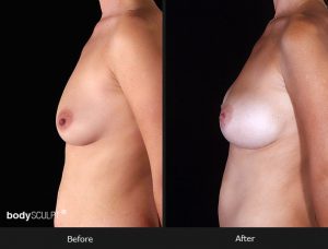 Composite Breast Augmentation - Patient 3