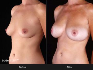 Composite Breast Augmentation - Patient 3