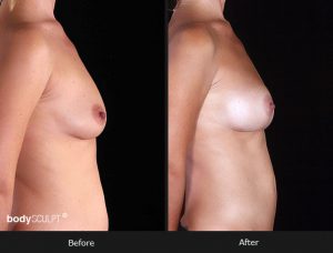 Composite Breast Augmentation - Patient 3