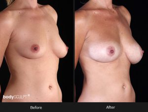 Composite Breast Augmentation - Patient 3