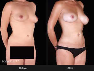 Composite Breast Augmentation - Patient 3