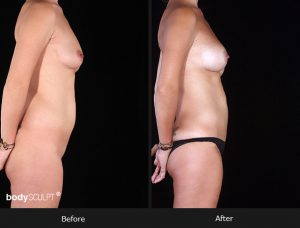 Composite Breast Augmentation - Patient 3