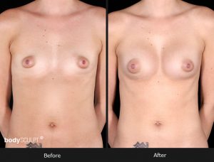 Composite Breast Augmentation - Patient 4