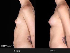 Composite Breast Augmentation - Patient 4