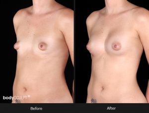 Composite Breast Augmentation - Patient 4