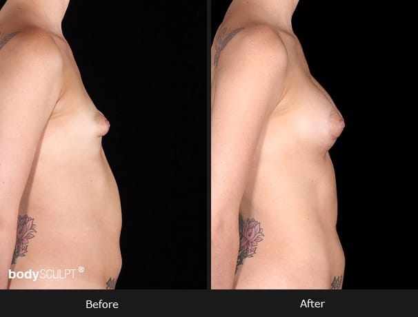 Composite Breast Augmentation - Patient 4