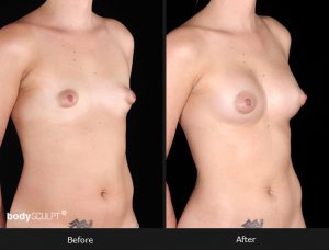 Composite Breast Augmentation - Patient 4