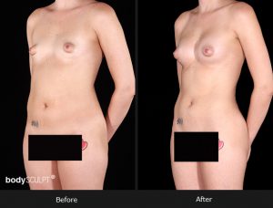 Composite Breast Augmentation - Patient 4