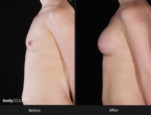 Composite Breast Augmentation - Patient 5