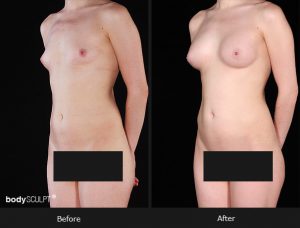 Composite Breast Augmentation - Patient 5