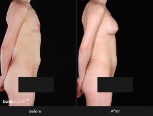 Composite Breast Augmentation - Patient 5