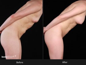 Composite Breast Augmentation - Patient 5