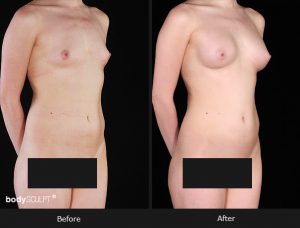 Composite Breast Augmentation - Patient 5