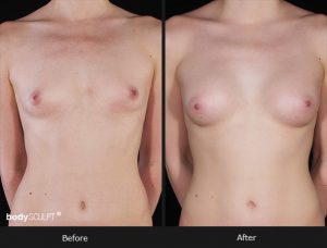 Composite Breast Augmentation - Patient 5