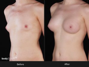 Composite Breast Augmentation - Patient 5