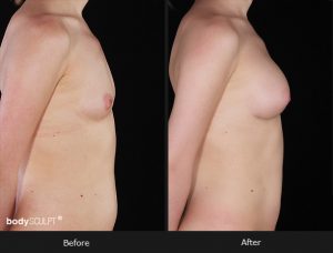 Composite Breast Augmentation - Patient 5