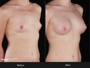 Composite Breast Augmentation - Patient 5