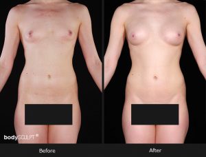 Composite Breast Augmentation - Patient 5