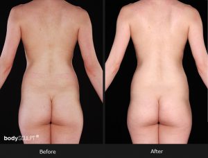 Composite Breast Augmentation - Patient 5