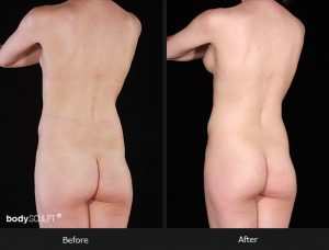 Composite Breast Augmentation - Patient 5