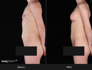 Composite Breast Augmentation - Patient 5