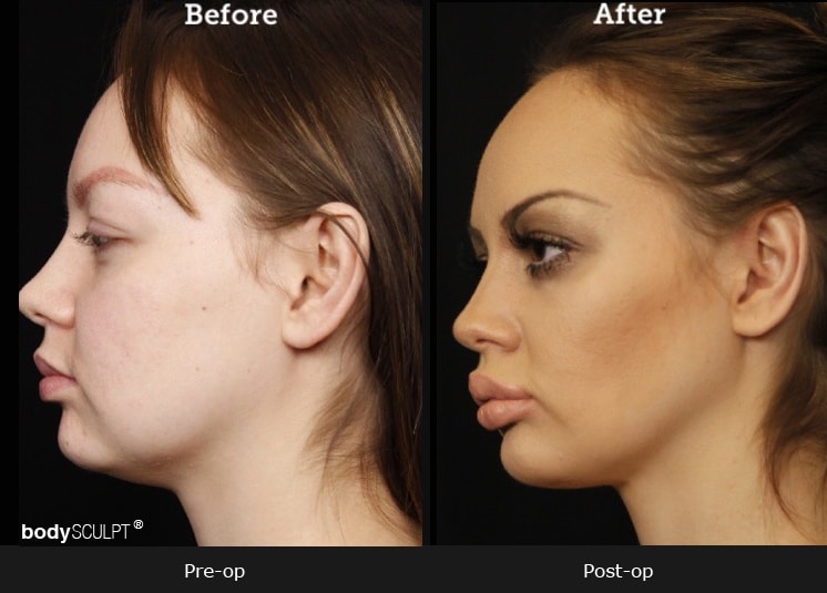 Chin Implant - Before & After Photos | bodySCULPT NYC