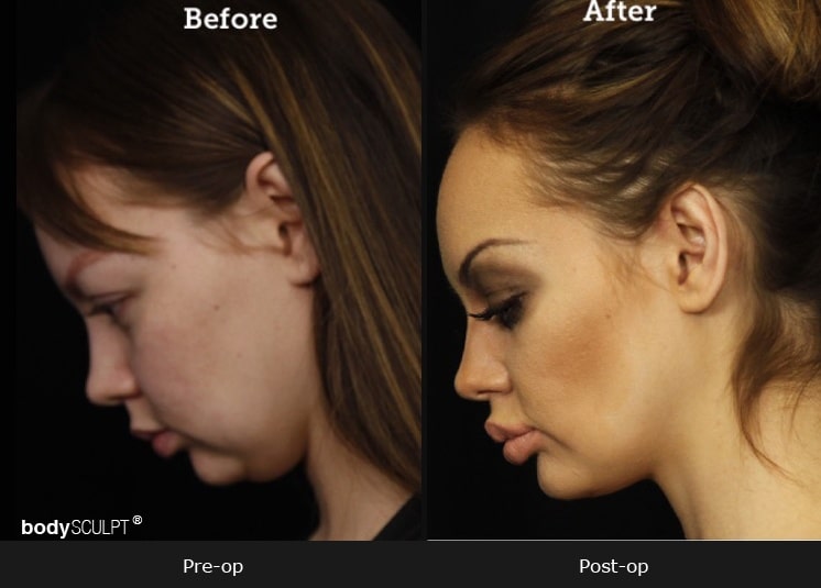 Chin Implant - Before & After Photos