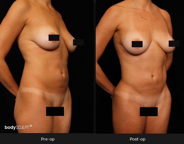 Female Hi Def Liposuction