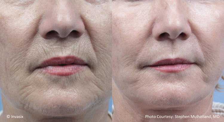 Fractora - Before and After Photos
