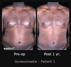 Gynecomastia - Patient 1