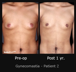 Gynecomastia - Patient 2