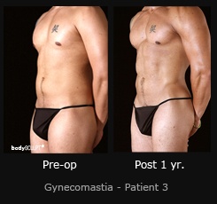 Gynecomastia