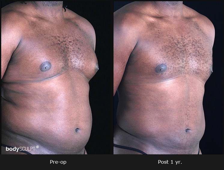 Gynecomastia - Patient 1