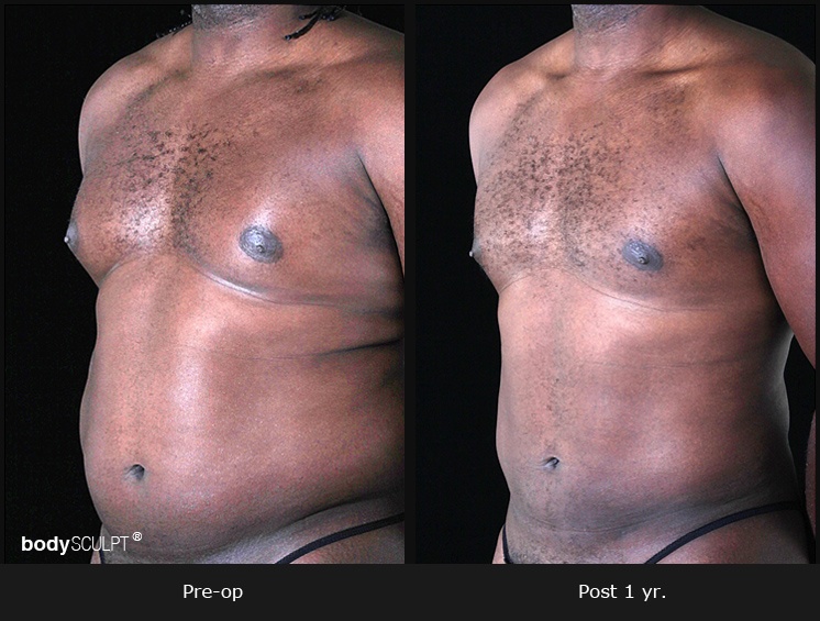 Gynecomastia - Patient 1