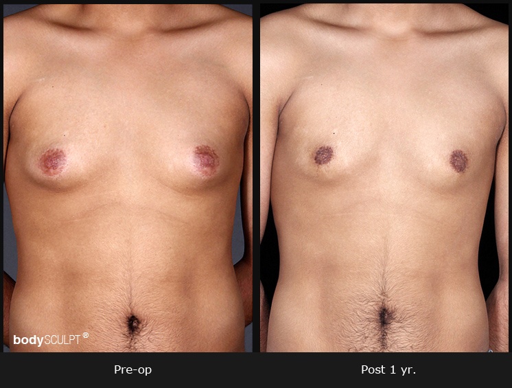 Gynecomastia - Patient 2