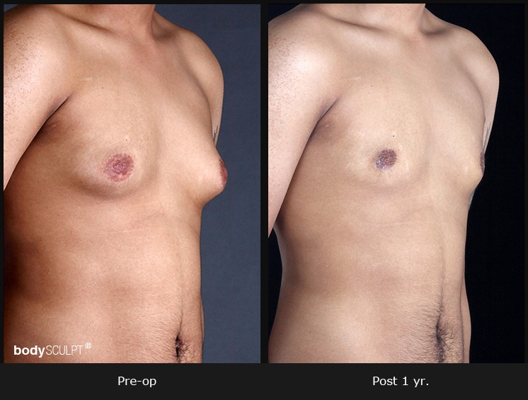 Gynecomastia - Patient 2