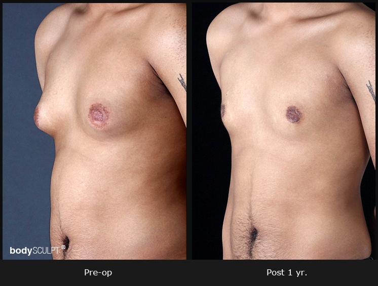 Gynecomastia - Patient 2