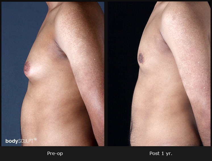 Gynecomastia - Patient 2