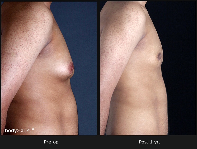 Gynecomastia - Patient 2