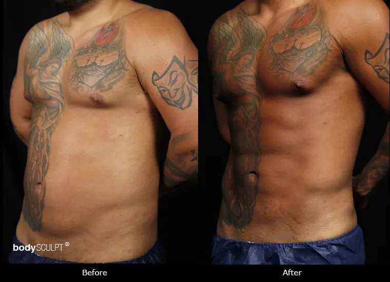 Smartlipo Love Handles Before and After Photos Men