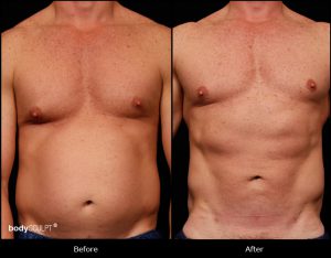 Smartlipo Abdomen (Men) - Patient 1