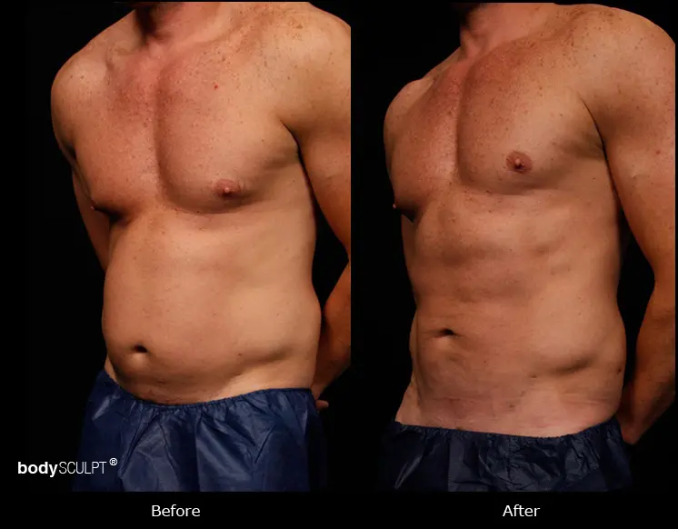 SmartLipo Abdomen - Before and After Photos