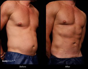 Smartlipo Abdomen - Patient 1