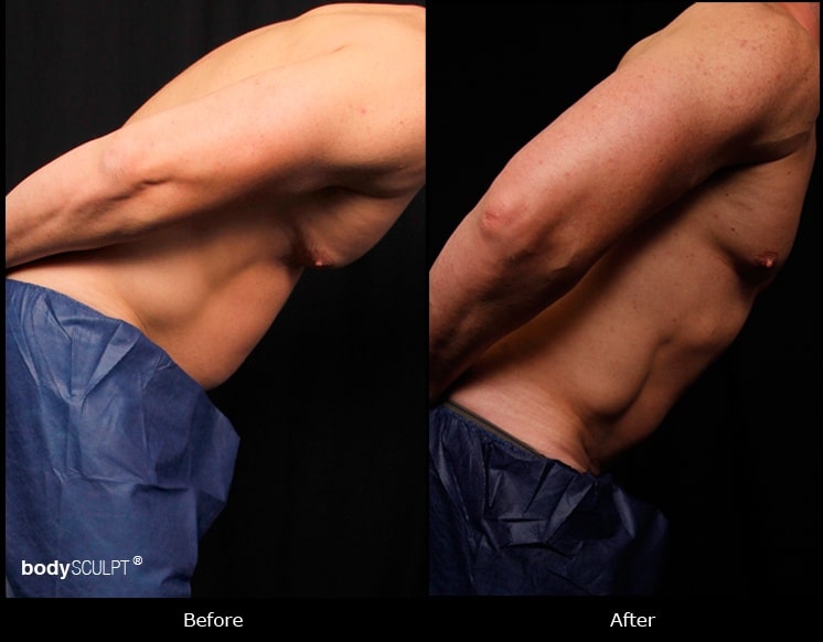 Male Abdomen Liposuction - Before and After Photos