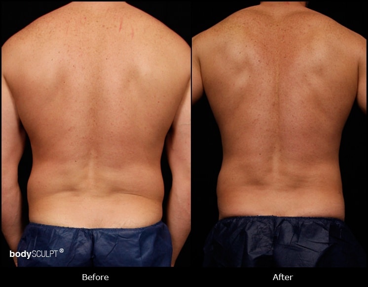 Abdomen Liposuction - Before and After Photos